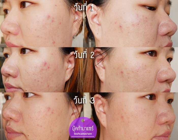 Clear-Expoet-sport-corrector-05-2