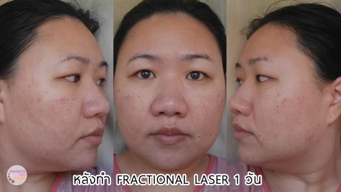 apex-profound-beauty-acen-ppp-beauty-fast-lane-07