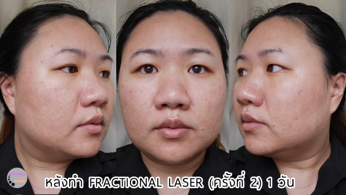 apex-profound-beauty-acen-ppp-beauty-fast-lane-12