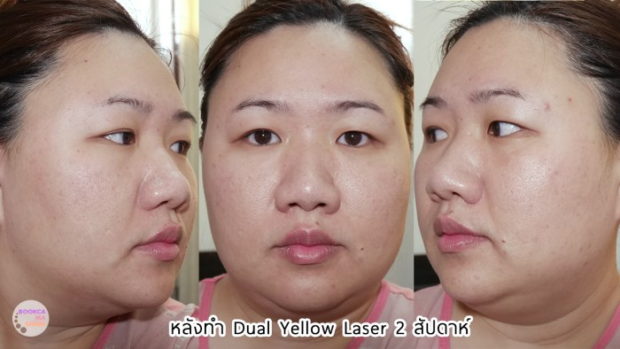 apex-profound-beauty-acen-ppp-beauty-fast-lane-19