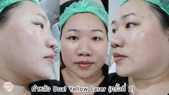 apex-profound-beauty-acen-ppp-beauty-fast-lane-22