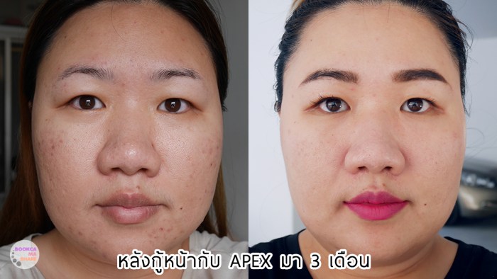 Apex-Profound-Beauty-acen-ppp-beauty-fast-lane-23-2