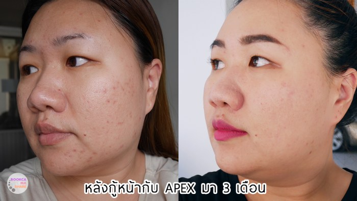 Apex-Profound-Beauty-acen-ppp-beauty-fast-lane-25-2