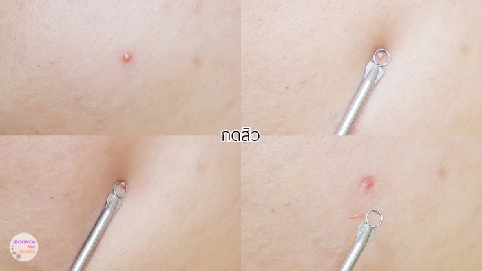 3m-nexcare-acne-dressing-uv-protect-4-2