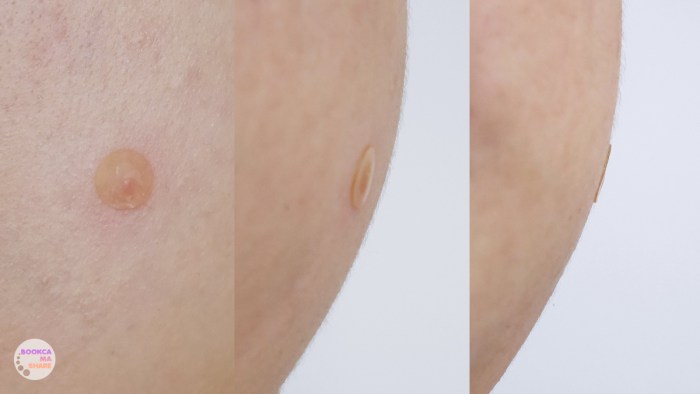 3m-nexcare-acne-dressing-uv-protect-6