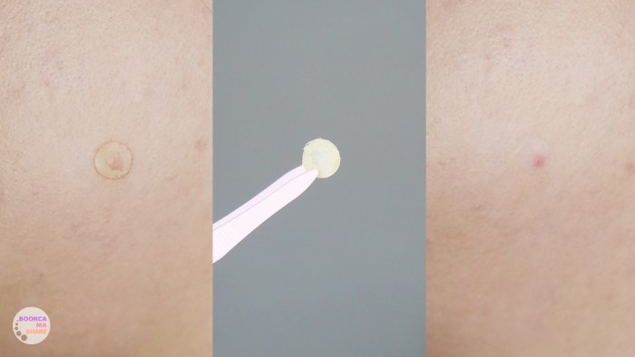 3m-nexcare-acne-dressing-uv-protect-8-1