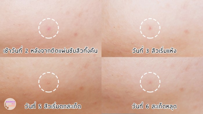 3m-nexcare-acne-dressing-uv-protect-8-2